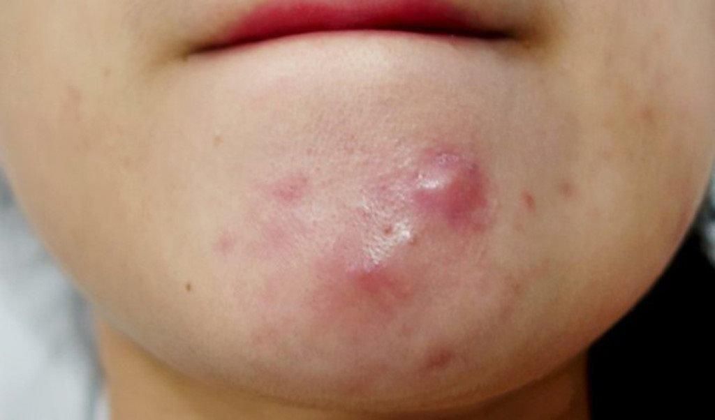 Mun-Cam-Li-Lap-Di-Lap-Lai-Vi-Sao-Mai-Khong-Het-_Mụn Cằm Lì, Lặp Đi Lặp Lại.jpg