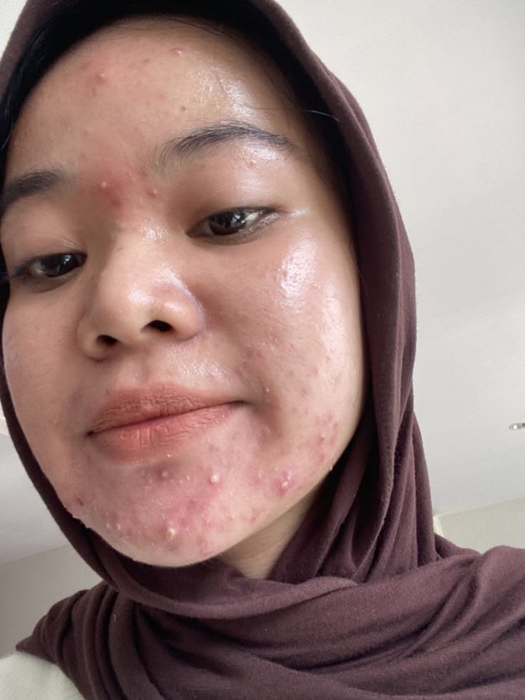 Mụn Sưng Viêm Thì Nên Chườm Đá Không?