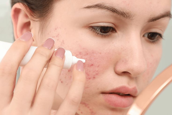 Mụn Viêm Bôi Tretinoin Có Hết Không?