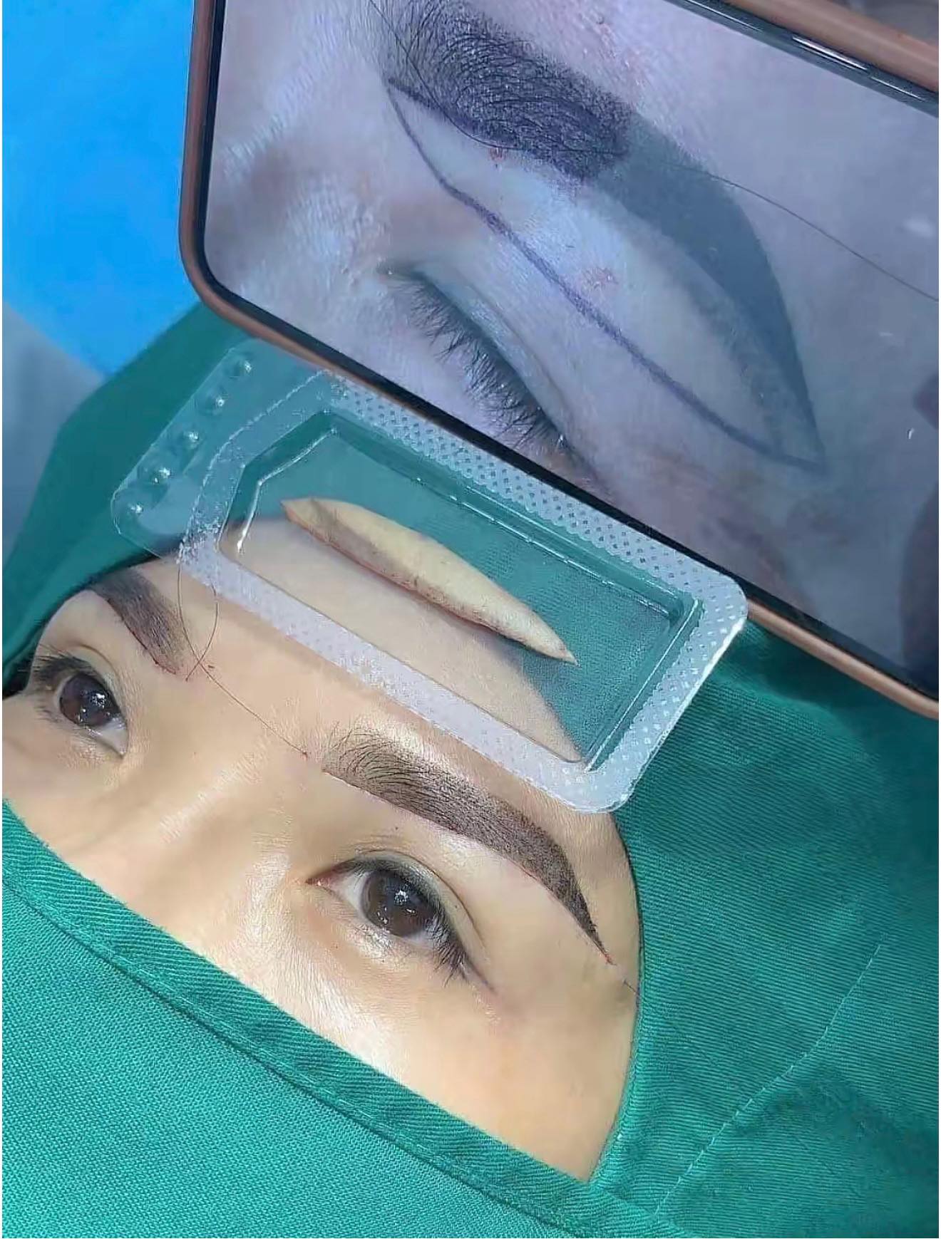 Nâng Cung Chân Mày Có Hết Sụp Mí Vĩnh Viễn Không?
