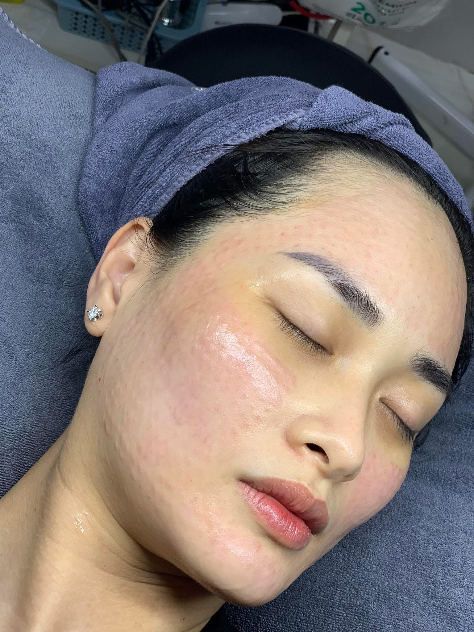 Người Da Nhạy Cảm Có Tiêm Meso Được Không?