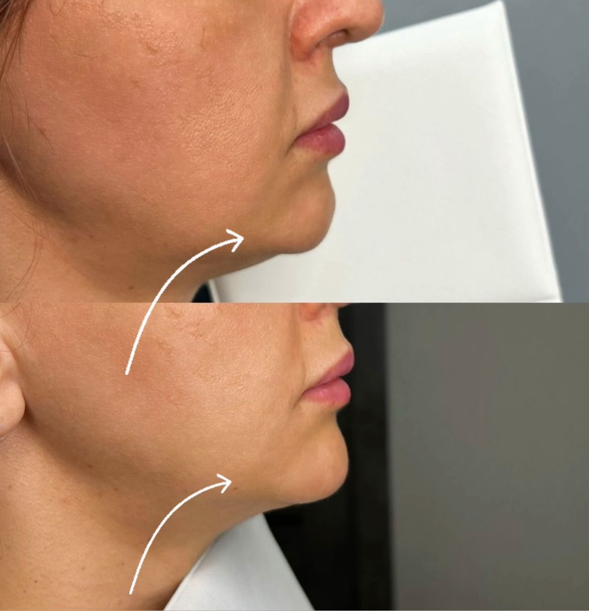 Nọng Cằm Do Đâu? 9 Nguyên Nhân Khiến Mặt Kém Thon Gọn