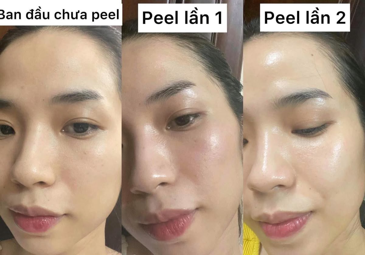 Peel-Da-Tri-Mun-Bao-Lau-Thi-Het-Mun-_Peel Da Trị Mụn Bao Lâu Thì Hết Mụn 1.jpg