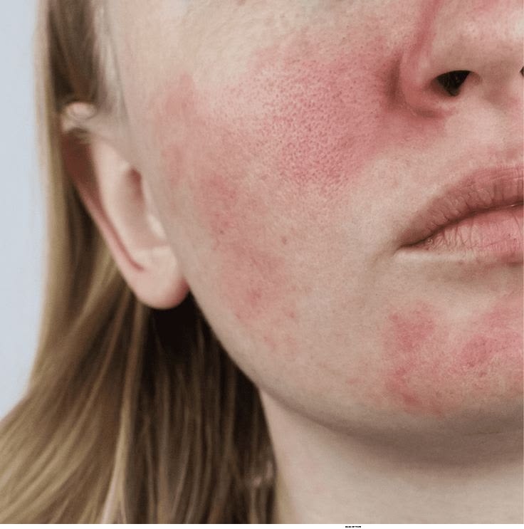 Phục Hồi Da Nhiễm Corticoid Đúng Cách – Lộ Trình Chuẩn Y Khoa
