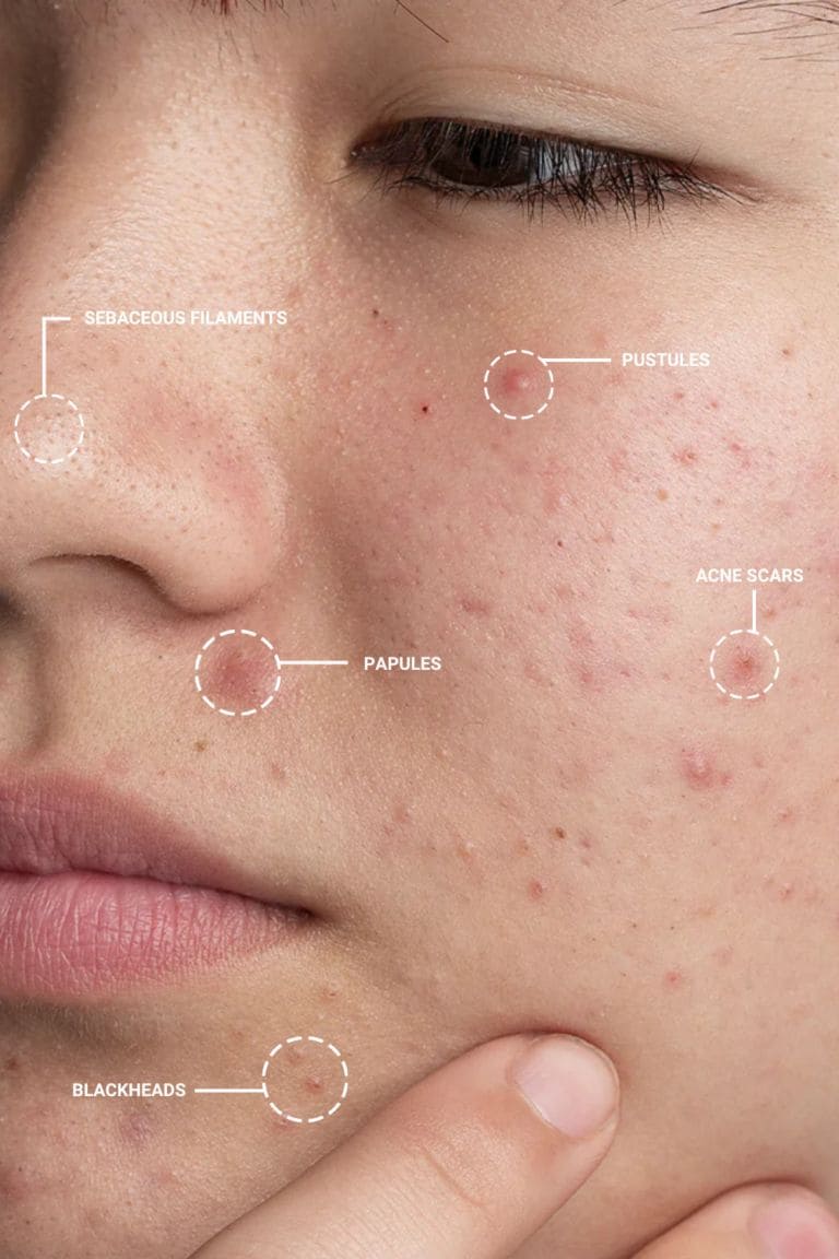 Routine-Tri-Mun-Cho-Da-Dau-Da-Hon-Hop-Da-Nhay-Cam_Routine Trị Mụn (3).jpg