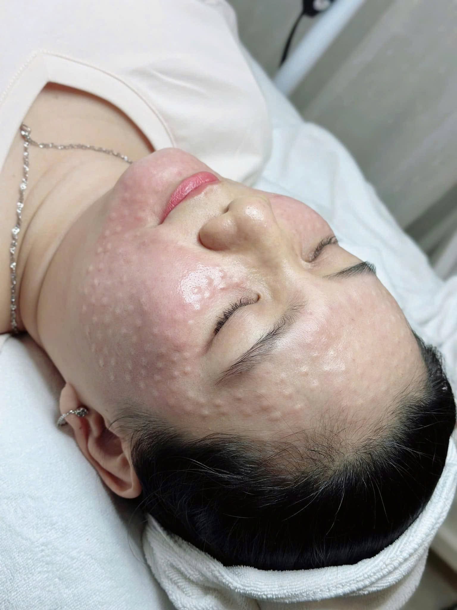 Tiêm Meso Có Giúp Da Glow Tự Nhiên Không?