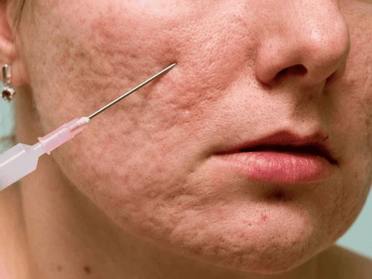 Tiêm Meso Trị Sẹo Rỗ Là Gì? Giá, Đặc Điểm & Cảnh Báo Y Khoa