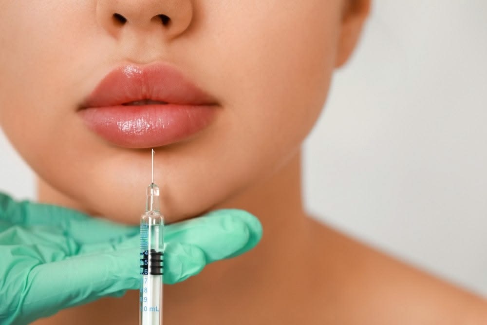 Tiêm Môi Bằng Filler Elasty Có Đẹp Không?