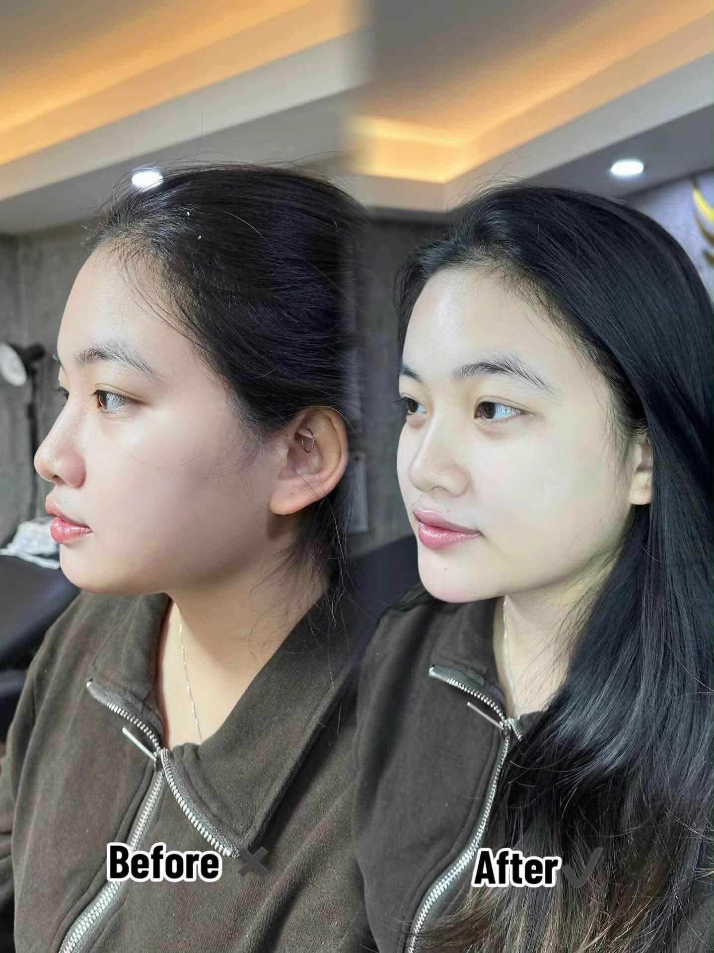 Tiêm filler cằm hay độn cằm?