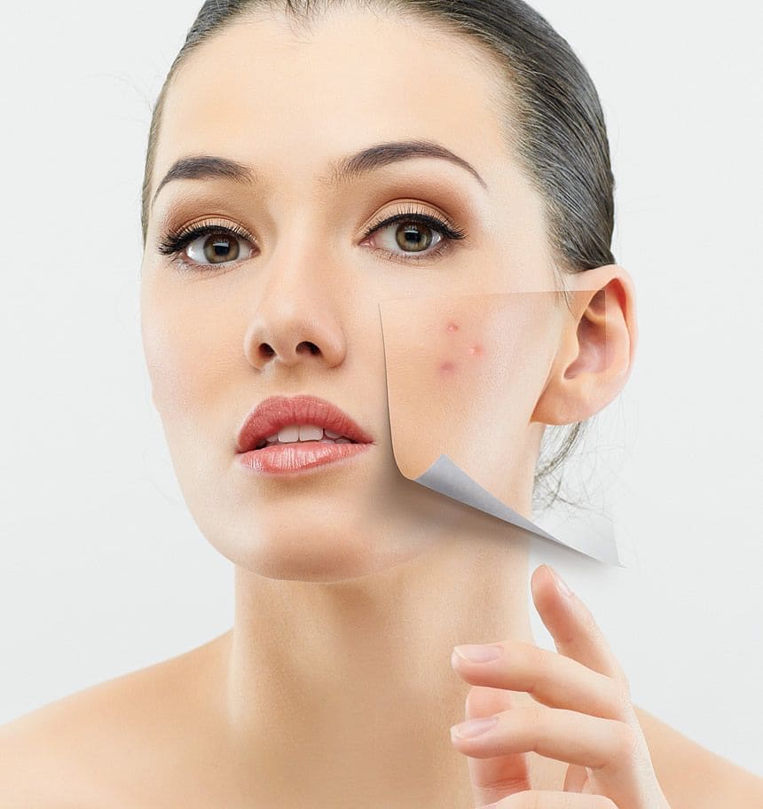 Tri-Mun-Khong-Hieu-Qua-Du-Da-Thu-Nhieu-San-Pham-Sai-O-Dau-_acne treatment (1).jpg