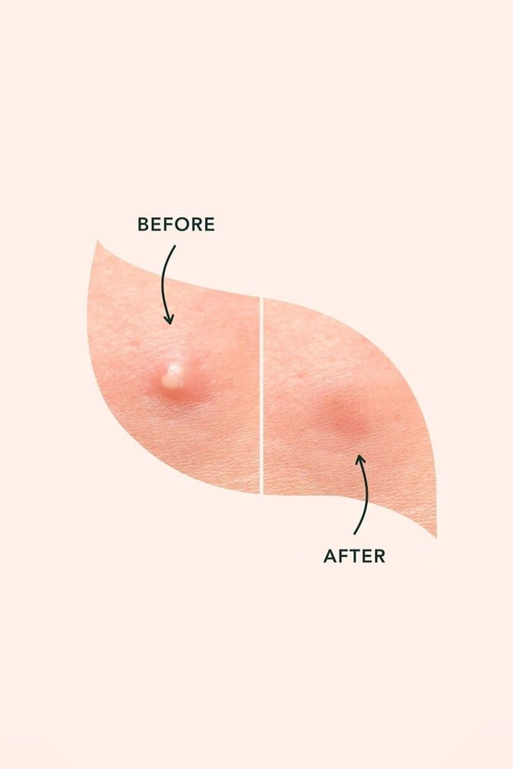 Tri-Mun-Khong-Hieu-Qua-Du-Da-Thu-Nhieu-San-Pham-Sai-O-Dau-_acne treatment (3).jpg