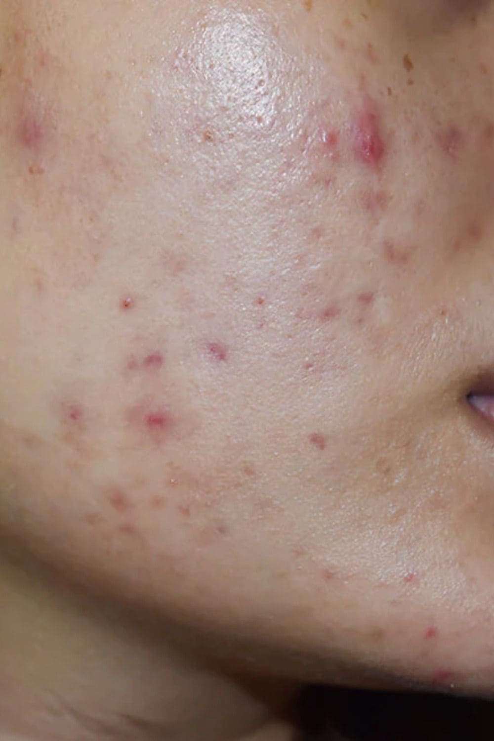 Tri-Mun-Xong-Bi-Tham-Seo-Cach-Lam-Mo-Va-Phuc-Hoi_Post Inflammatory Erythema (1).jpg