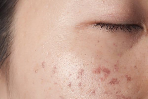 Tri-Mun-Xong-Bi-Tham-Seo-Cach-Lam-Mo-Va-Phuc-Hoi_Post Inflammatory Hyperpigmentation (1).jpg