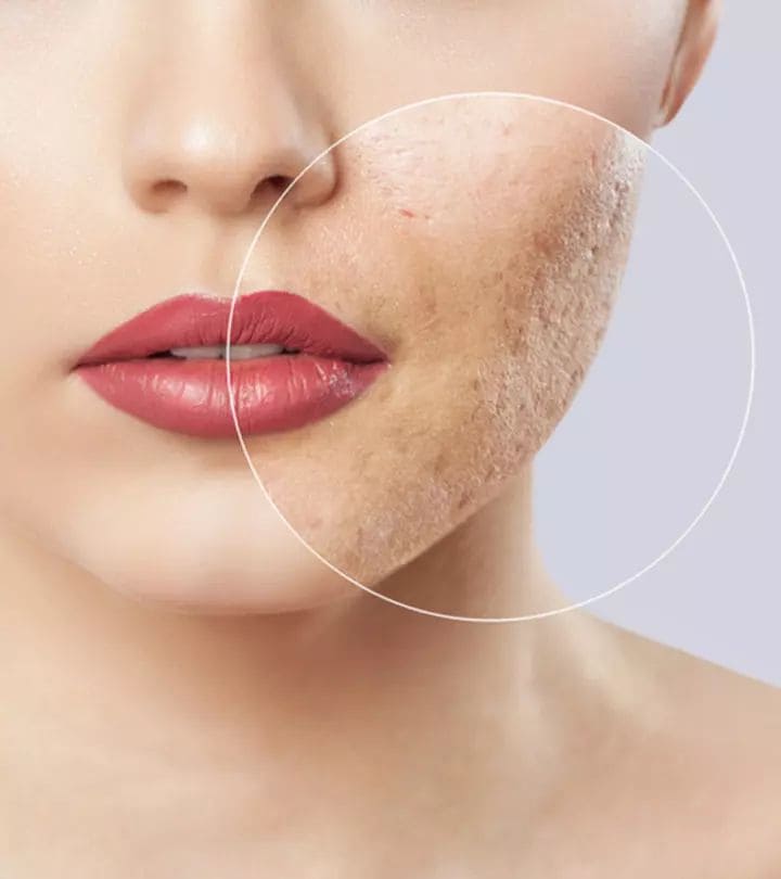 Tri-Mun-Xong-Bi-Tham-Seo-Cach-Lam-Mo-Va-Phuc-Hoi_scar acne (1).jpg