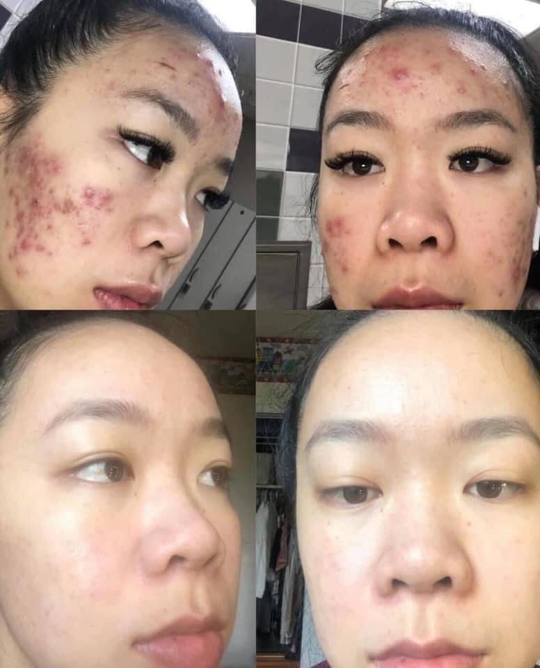 Vi-Sao-Boi-Nhieu-Thuoc-Mun-Nhung-Mun-Viem-Khong-Giam-_Vì Sao Bôi Nhiều Thuốc Mụn Nhưng Mụn Viêm Không Giảm 2.jpg