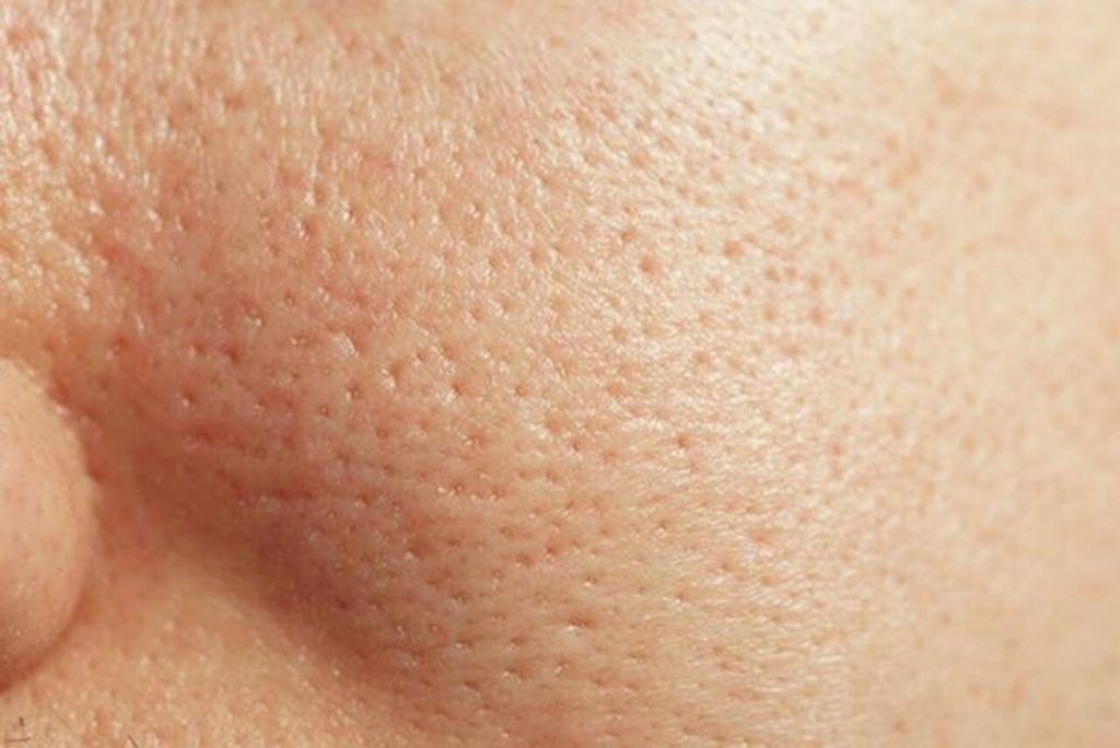 Vì Sao Càng Nặn Mụn Lỗ Chân Lông Càng To?