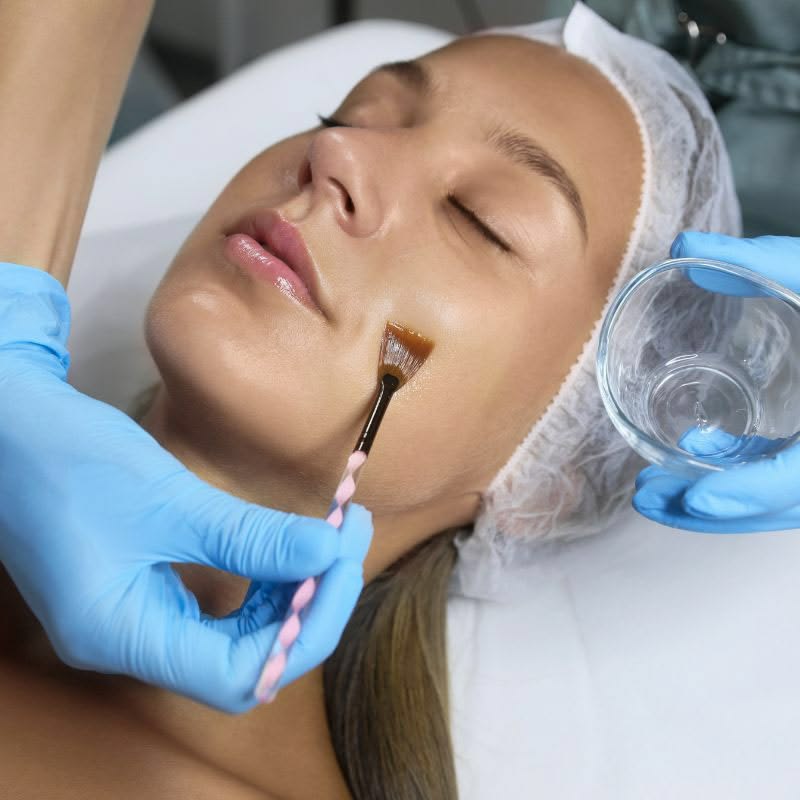 Vì Sao Nhiều Người Chọn Peel Da Trị Mụn?