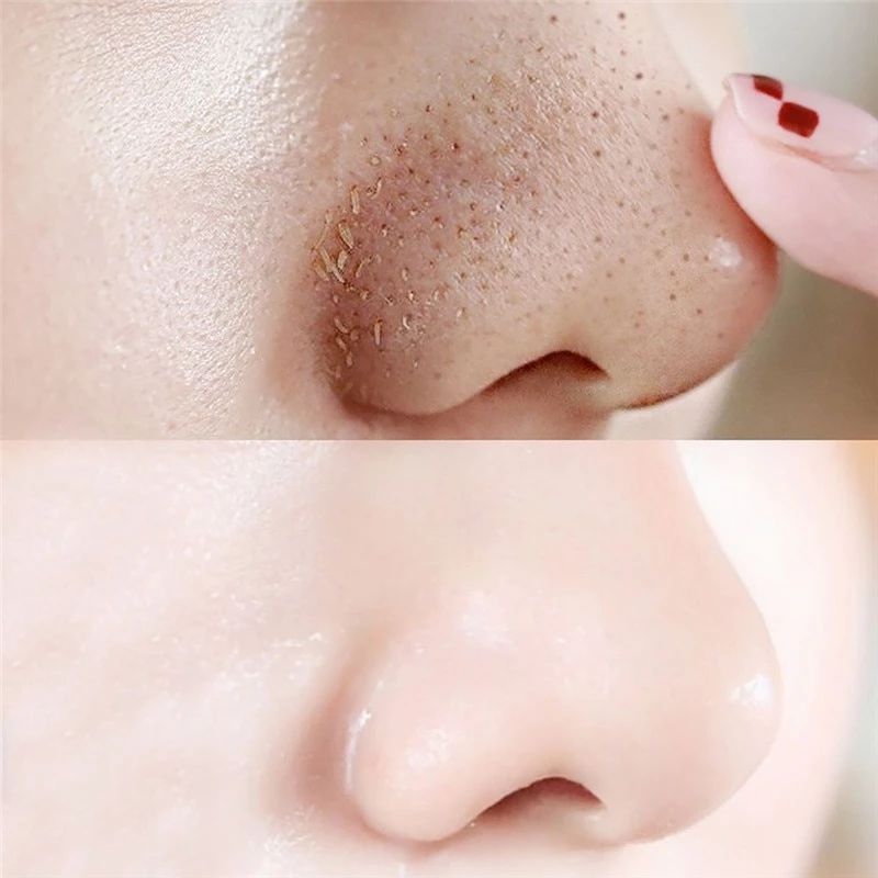 Vì Sao Sợi Bã Nhờn Xuất Hiện Nhiều Ở Mũi, Cằm?