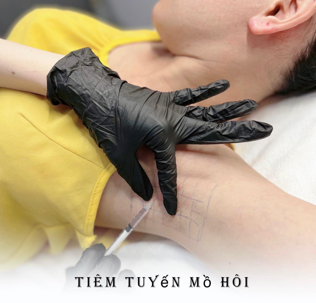 Botox-tri-tang-tiet-mo-hoi-co-hieu-qua-khong--3.jpg