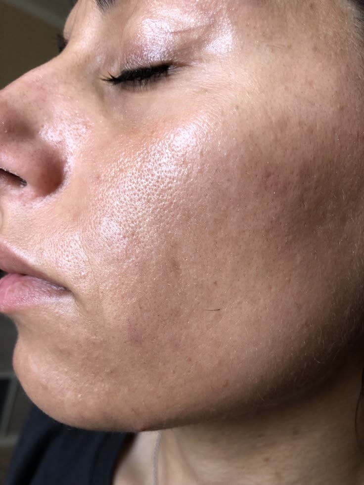 Da Tiết Nhiều Dầu. 8 Nguyên Nhân Phổ Biến Và Cách Kiểm Soát Hiệu Quả.jpg
