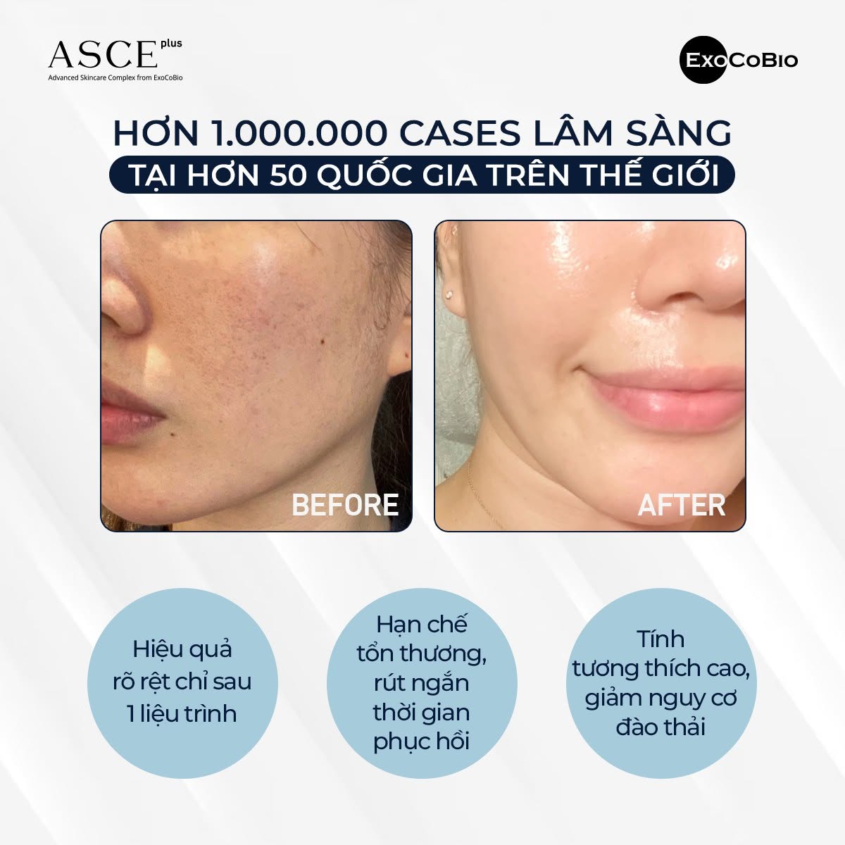 Exosome Asce Có Tốt Không. Công Dụng Và Lưu Ý Khi Làm Meso 2.jpg