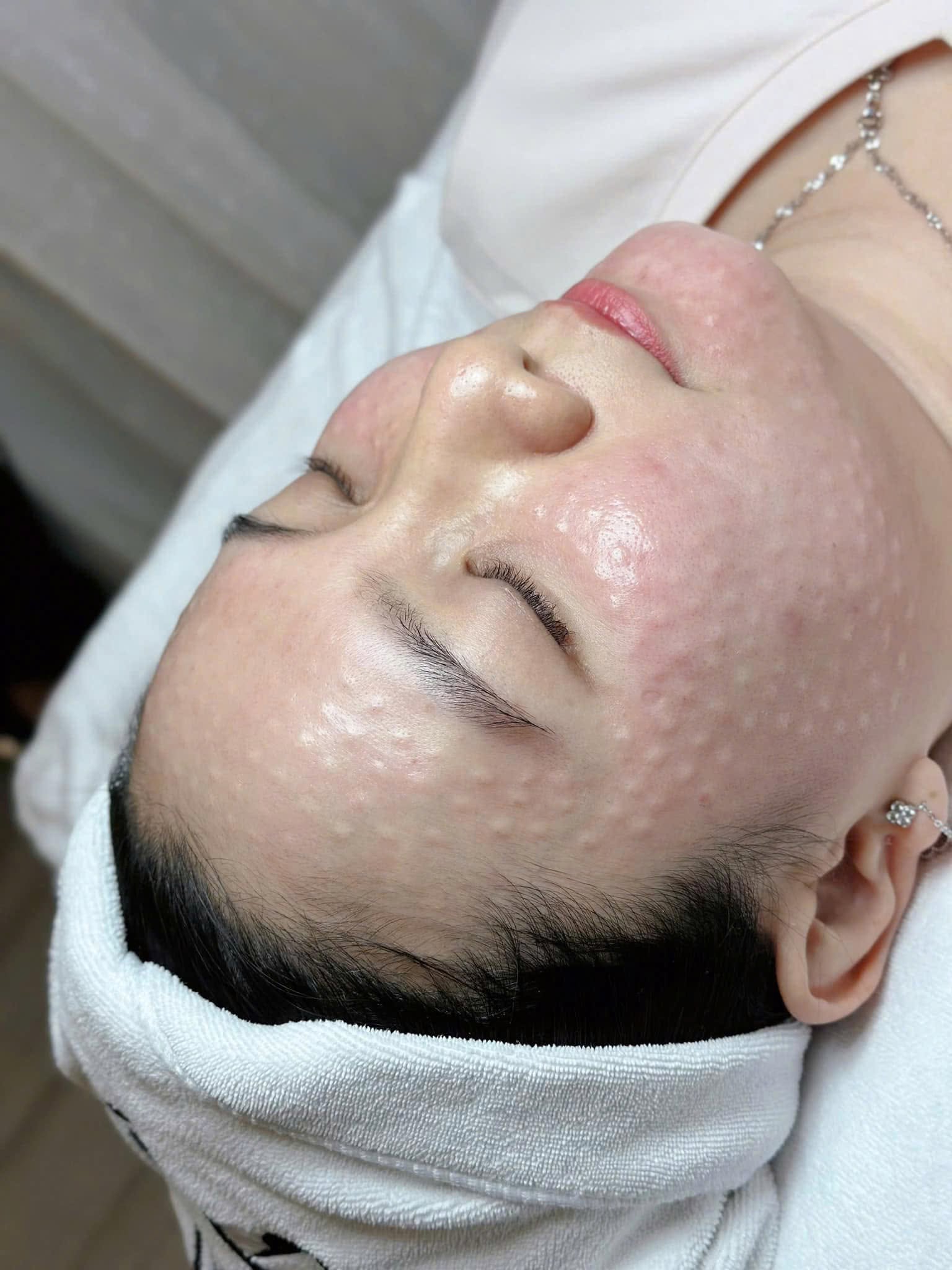 Huong-Dan-Cham-Soc-Sau-Tiem-Meso-De-Dat-Hieu-Qua-Toi-Uu-3.jpg