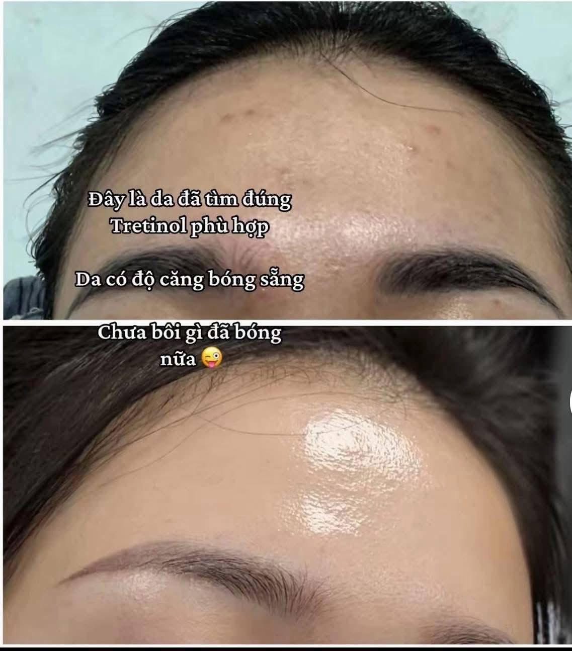 Nguoi-Moi-Co-Nen-Dung-Tretinoin-0-05-Khong--1.jpg