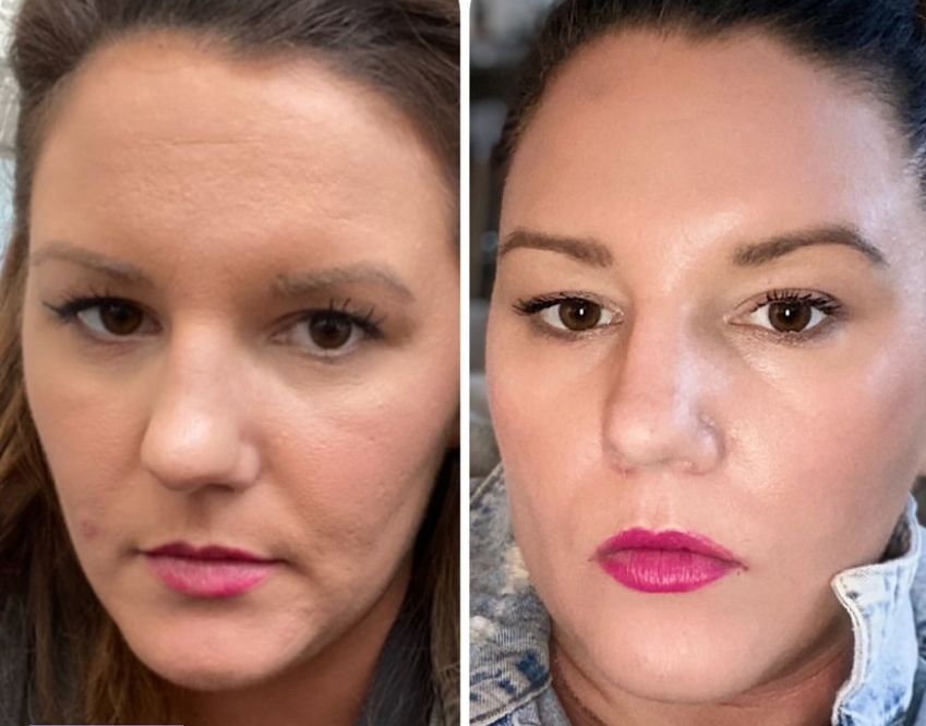 Review-Cac-Loai-Tretinoin-Tri-Mun-Tot-Nhat-Hien-Nay-3.jpg