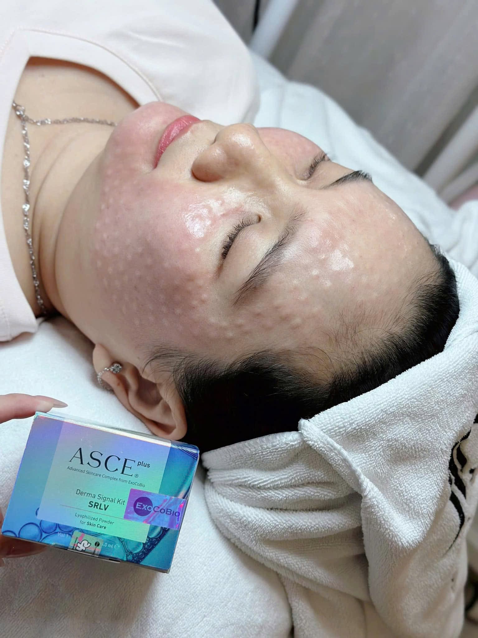 Tiem-Meso-Co-Giup-Da-Glow-Tu-Nhien-Khong--1.jpg