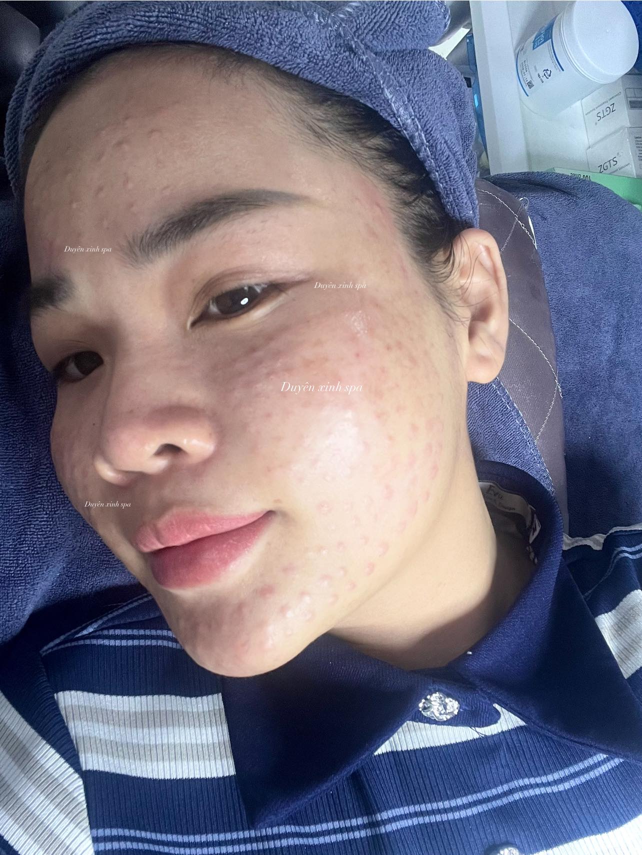 Tiem-Meso-Co-Giup-Se-Khit-Lo-Chan-Long-Khong--1.jpg