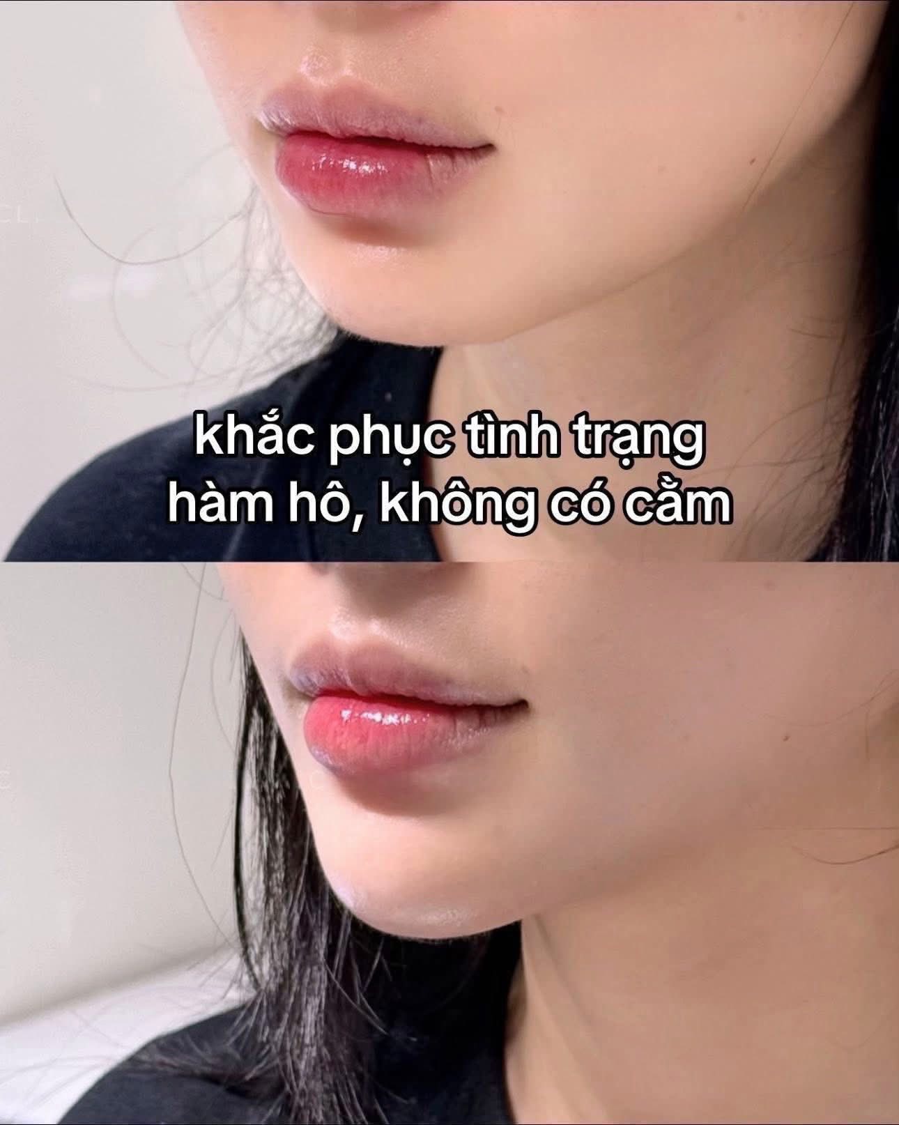 Tiem-filler-cam-hay-don-cam--1.jpg