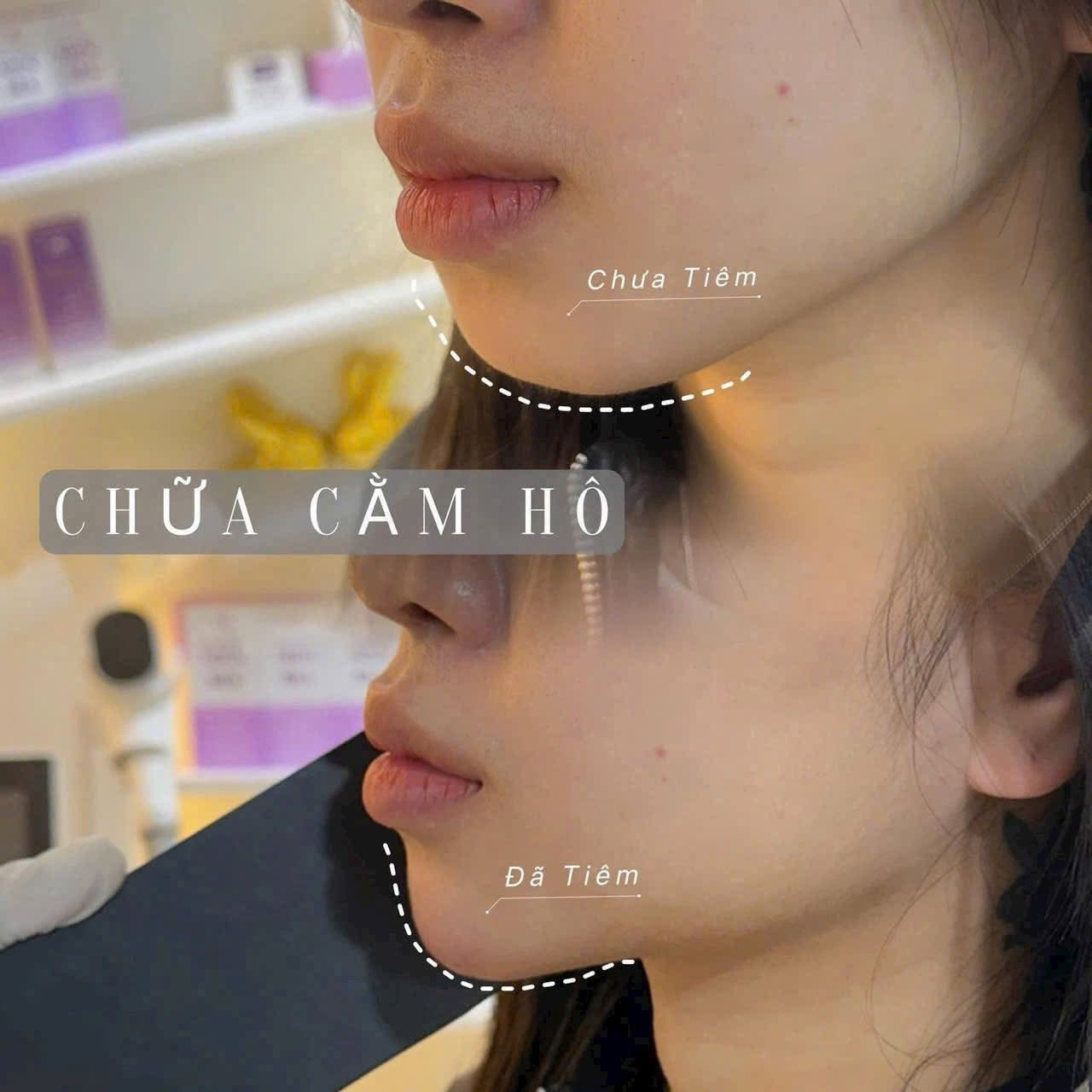 Tiem-filler-cam-hay-don-cam--2.jpg