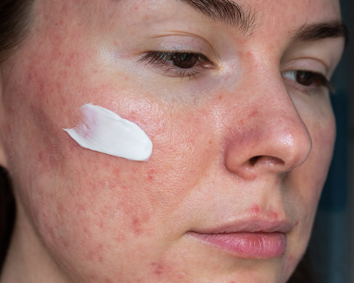 Tretinoin-Dung-Nhieu-Co-Lon-Da-Khong--1.jpg