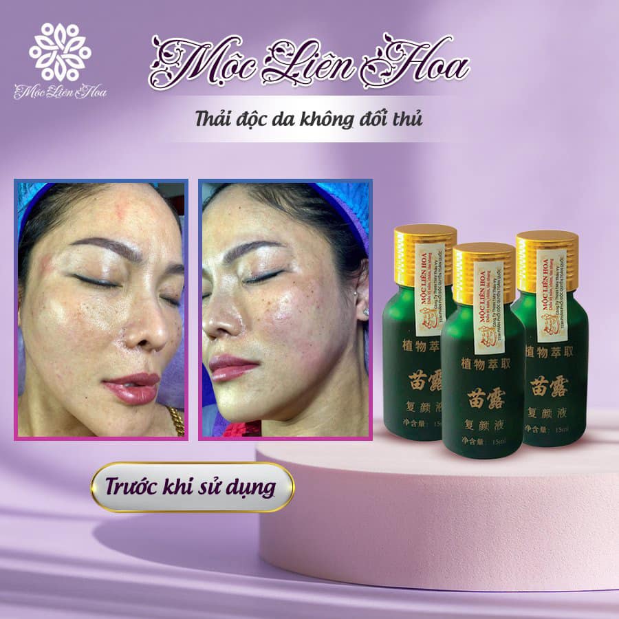 Mộc Liên Hoa Ultra Spot - Tinh chất mờ nám, tàn nhang chính hãng