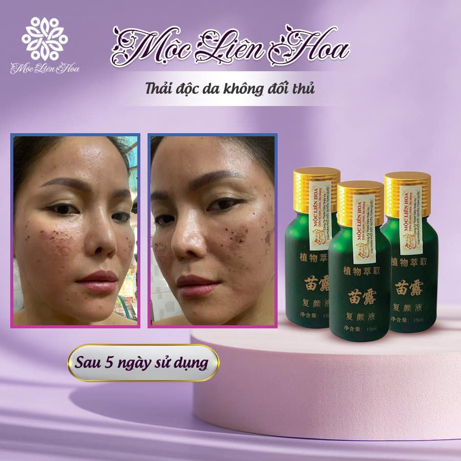 Mộc Liên Hoa Ultra Spot - Tinh chất mờ nám, tàn nhang chính hãng