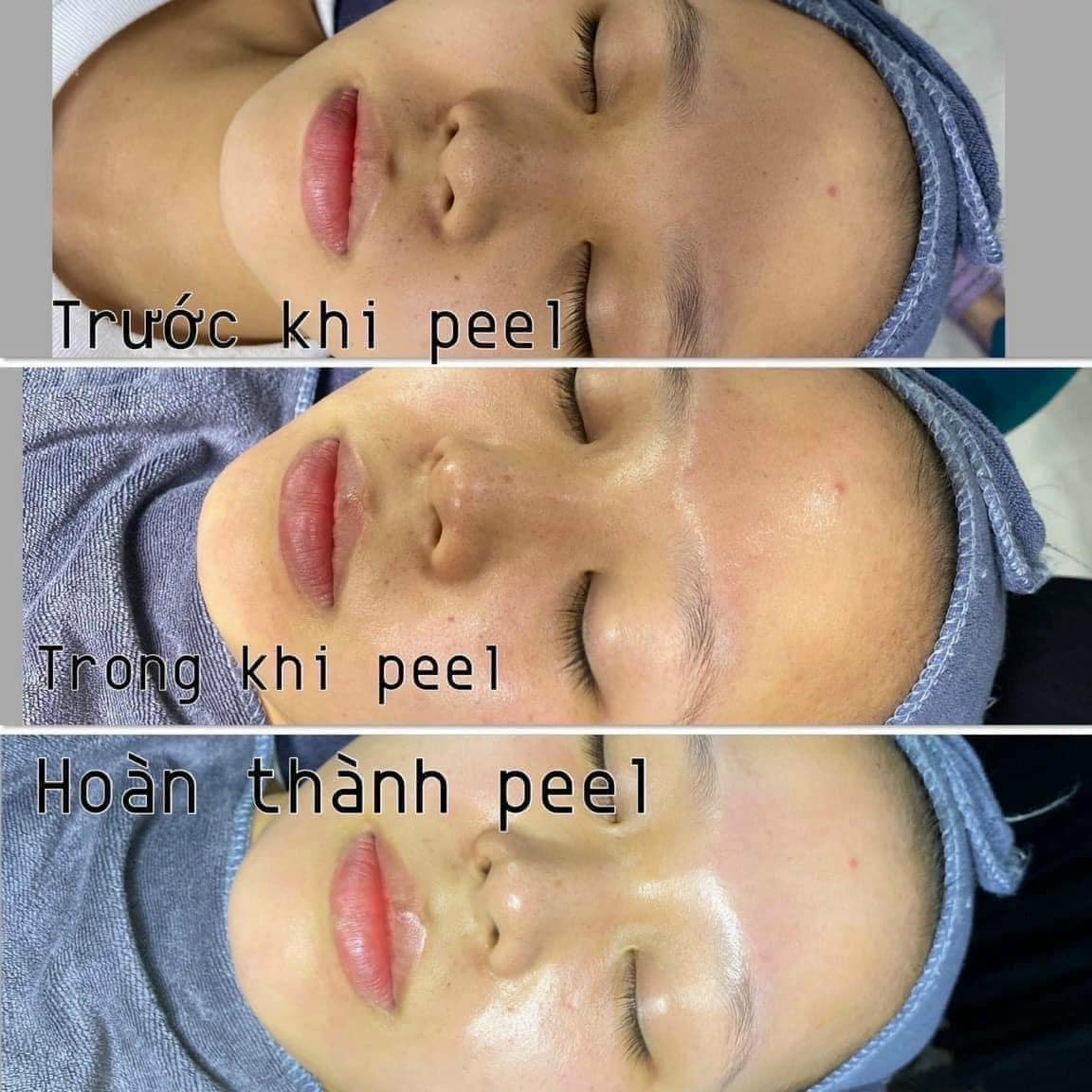 Peel trị mụn ẩn, đầu đen trẻ hóa da Lightening innoaesthetics