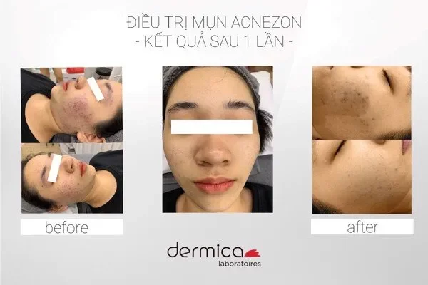 Dermica Acne Zon/Acnezon - Huyết thanh loại bỏ mụn cường độ cao, se còi, gom nhân mụn