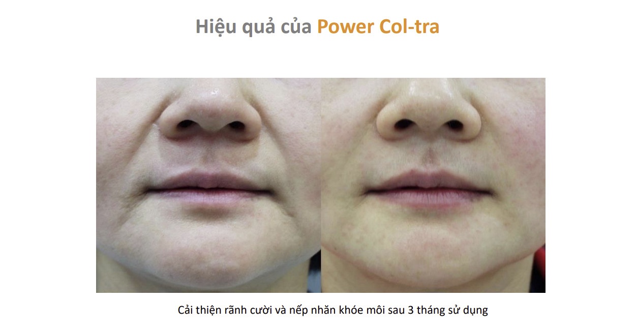 Bột chỉ tăng sinh collagen, làm đầy PCL Power Booster