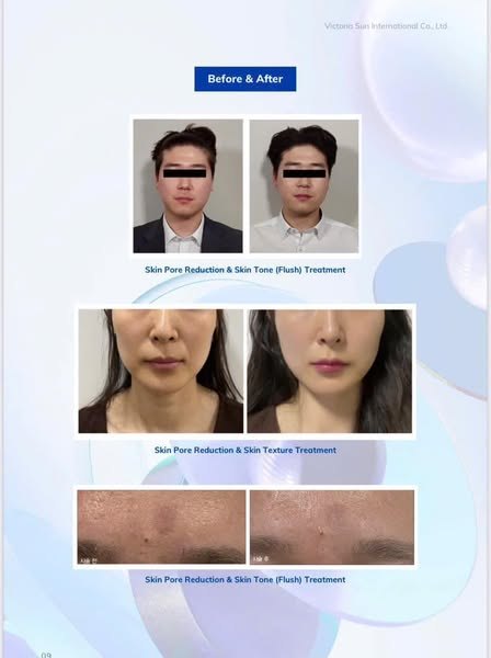 Bột chỉ tăng sinh Collagen trẻ hóa da PLLA POLYSOME