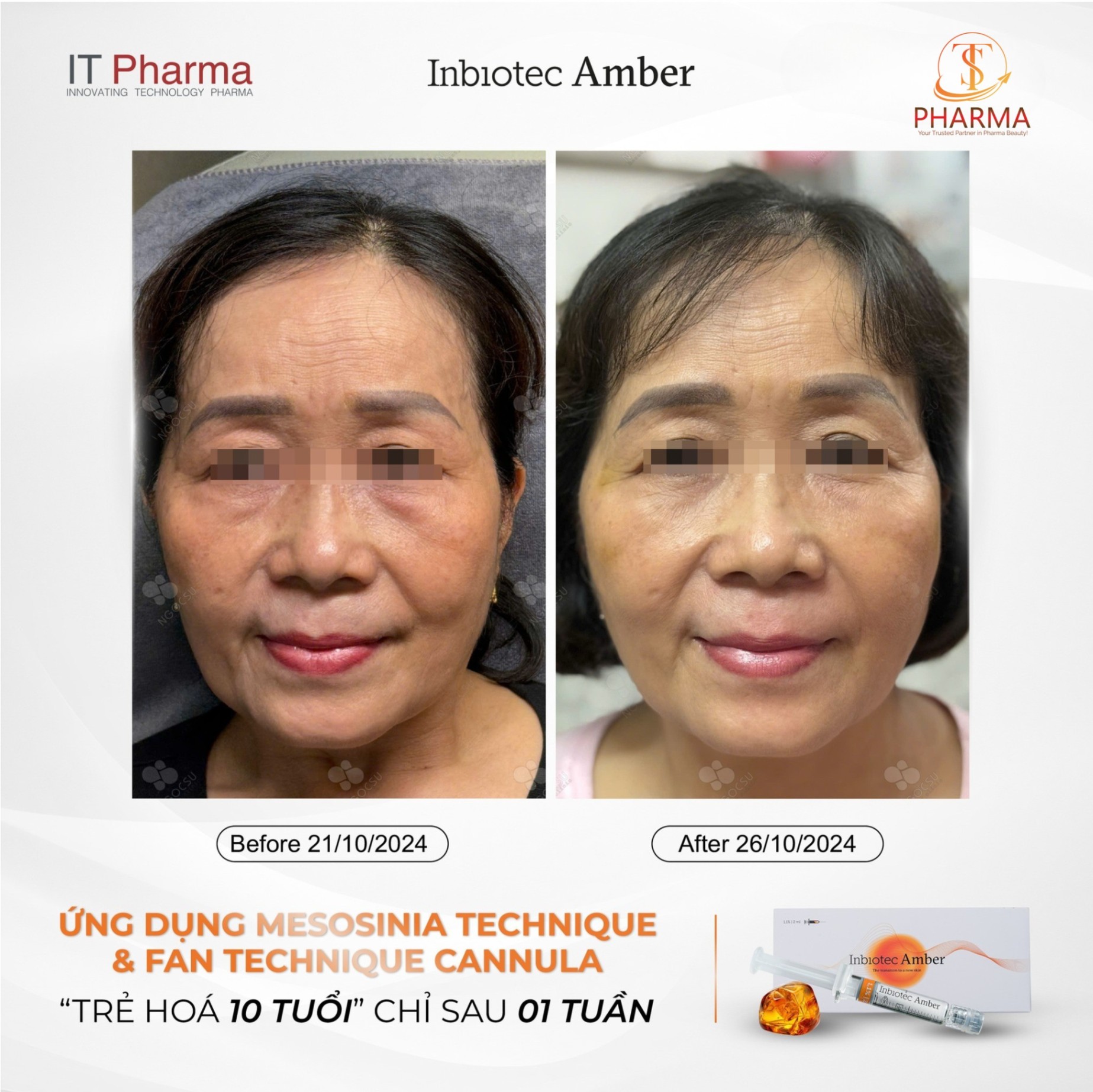 Tiêm B.A.P trẻ hoá đa tầng Inbiotec Amber