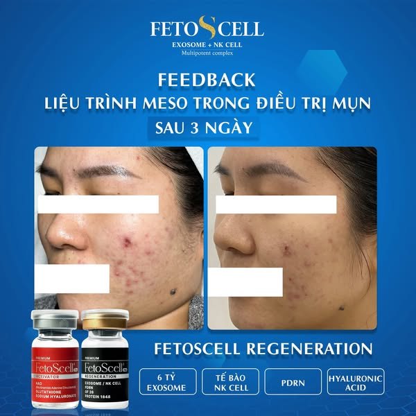 FetoScell White 40mg – Meso Hỗ Trợ Làm Đều Màu Da Và Giúp Cải Thiện Sắc Da