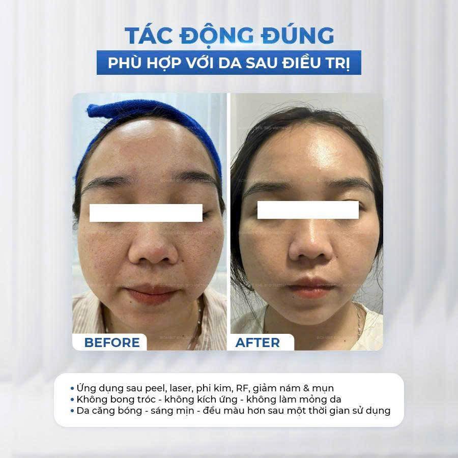 BOMBIT TOTAL SOLUTION AMPOULE TÁI TẠO DA TỔN THƯƠNG