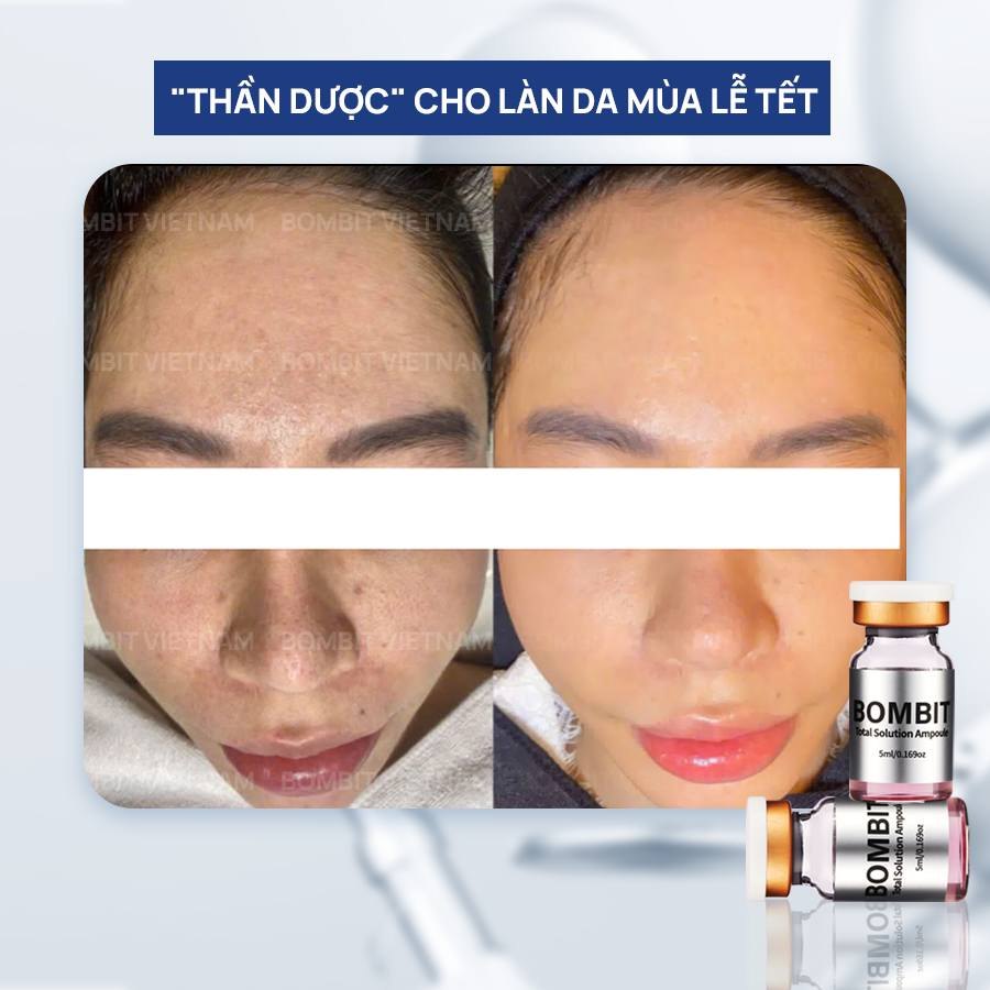 BOMBIT TOTAL SOLUTION AMPOULE TÁI TẠO DA TỔN THƯƠNG