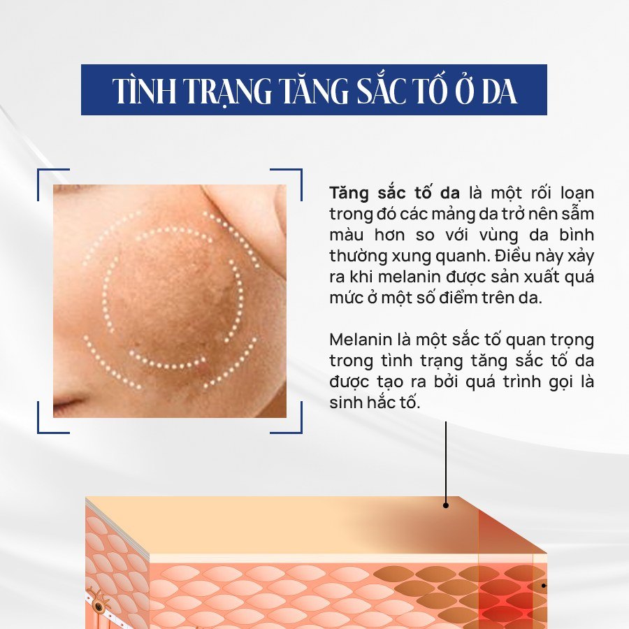BOMBIT Snow Meso hỗ trợ điều trị nám, làm trắng da