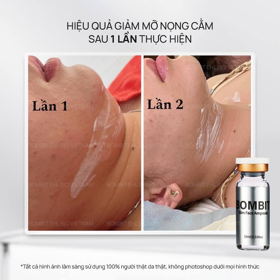 BOMBIT Slim Face thon gọn mặt, tan mỡ má, nọng cằm