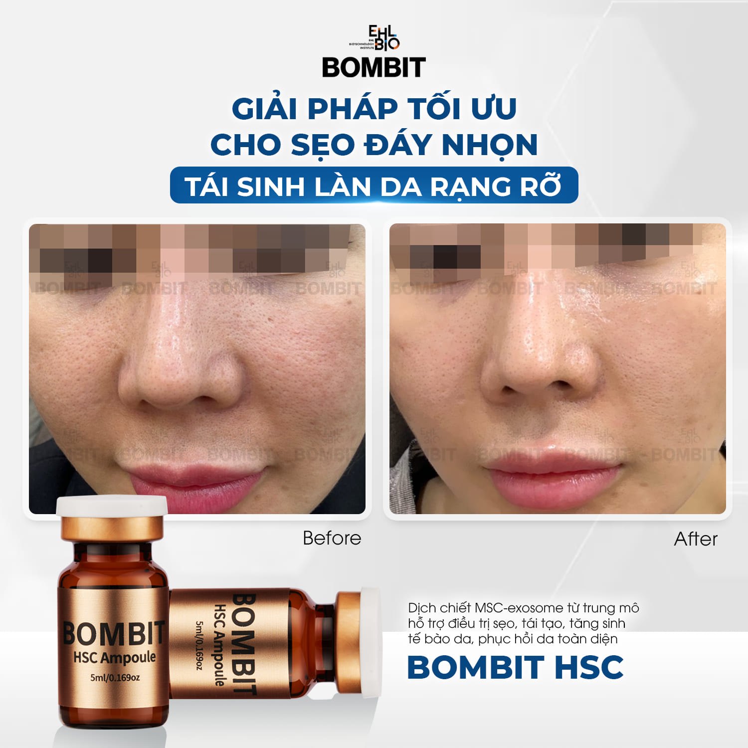 Bombit Meso HSC Exosome tái tạo tế bào phục hồi da