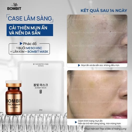 BOMBIT Snow Meso hỗ trợ điều trị nám, làm trắng da