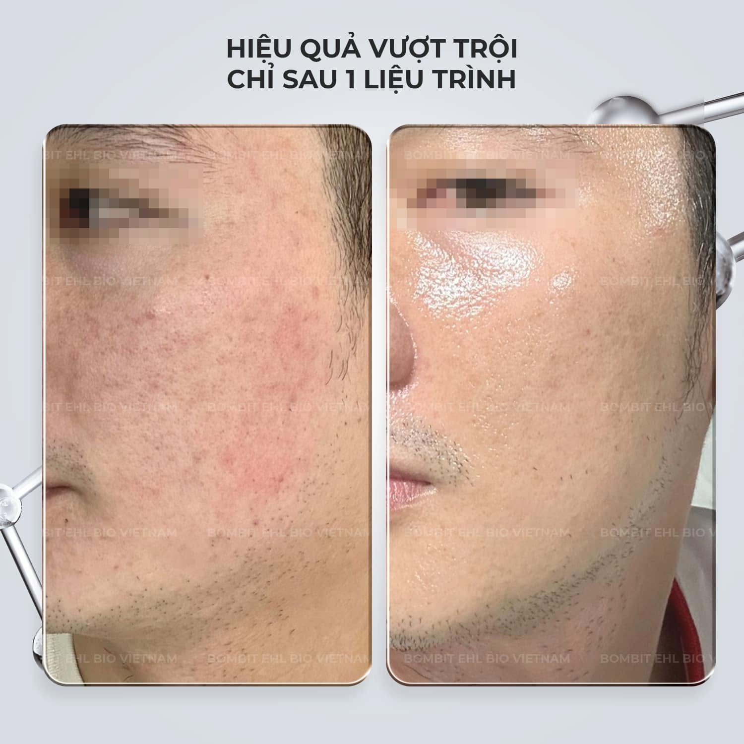 BOMBIT Slim Face thon gọn mặt, tan mỡ má, nọng cằm