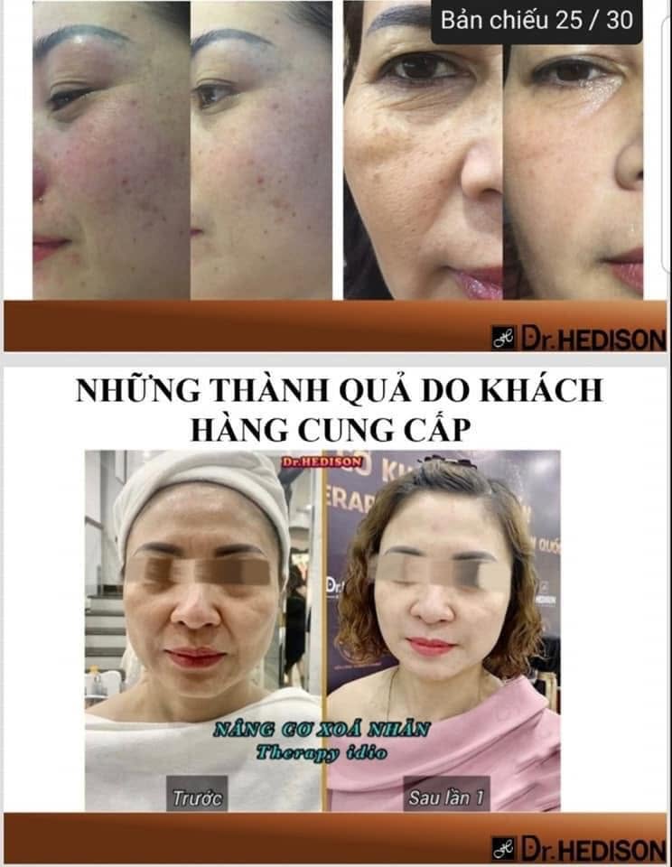 Bộ Sản Phẩm Choco Therapy IDIO Dr.Hedison | Liệu Pháp Nâng Cơ Không Xâm Lấn, Trẻ Hóa Da