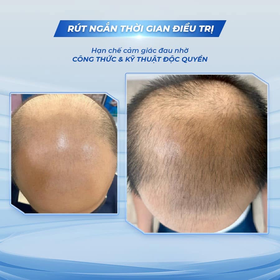 Bombit Hair Meso MSC Exosome hổ trợ mọc tóc, giảm rụng tóc